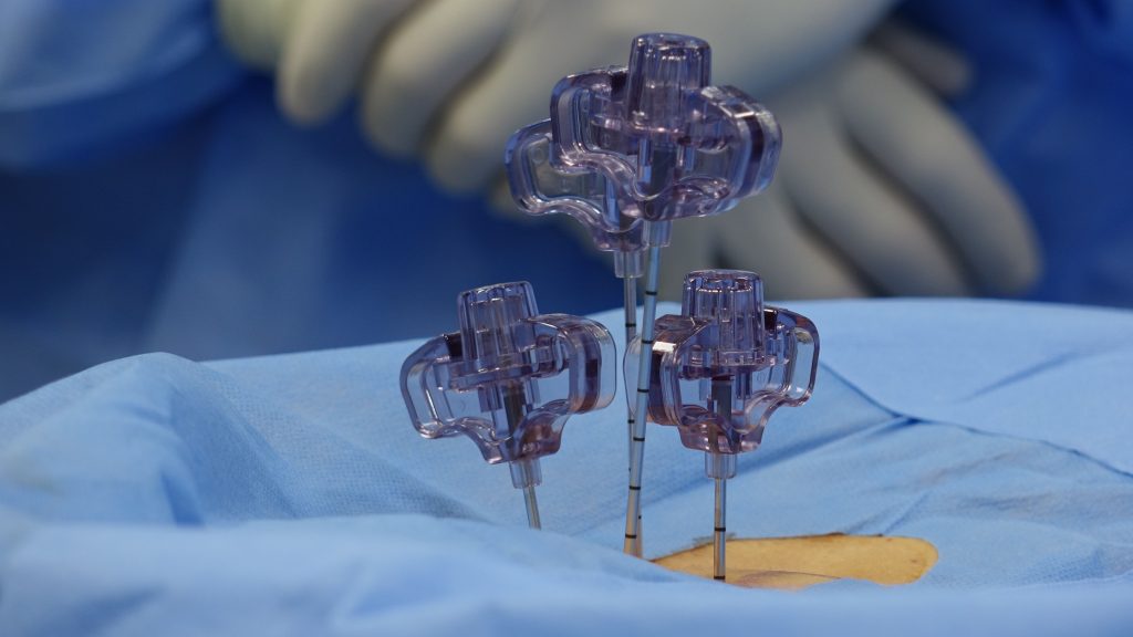 Spinal Stenosis Close view of surgical tools during a spinal procedure in an OR.