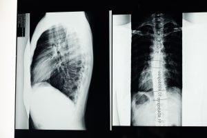 Patient Resources High-resolution X-ray showing a detailed examination of human spine with scoliosis.