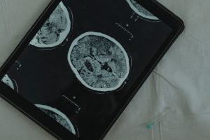 Patient Resources Close-up view of a brain CT scan displayed on a digital tablet with a medical needle beside it.