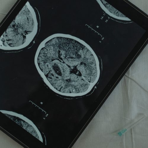 Close-up view of a brain CT scan displayed on a digital tablet with a medical needle beside it.